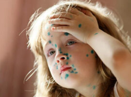 Ветряная оспа в курсе, что с «короной» Минздрав накосячил — и бесчинствует в российских регионах