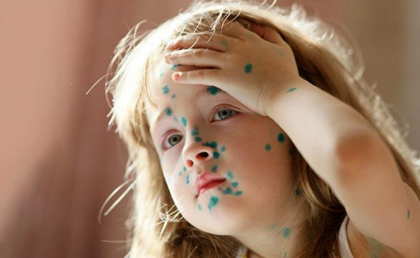 Ветряная оспа в курсе, что с «короной» Минздрав накосячил — и бесчинствует в российских регионах